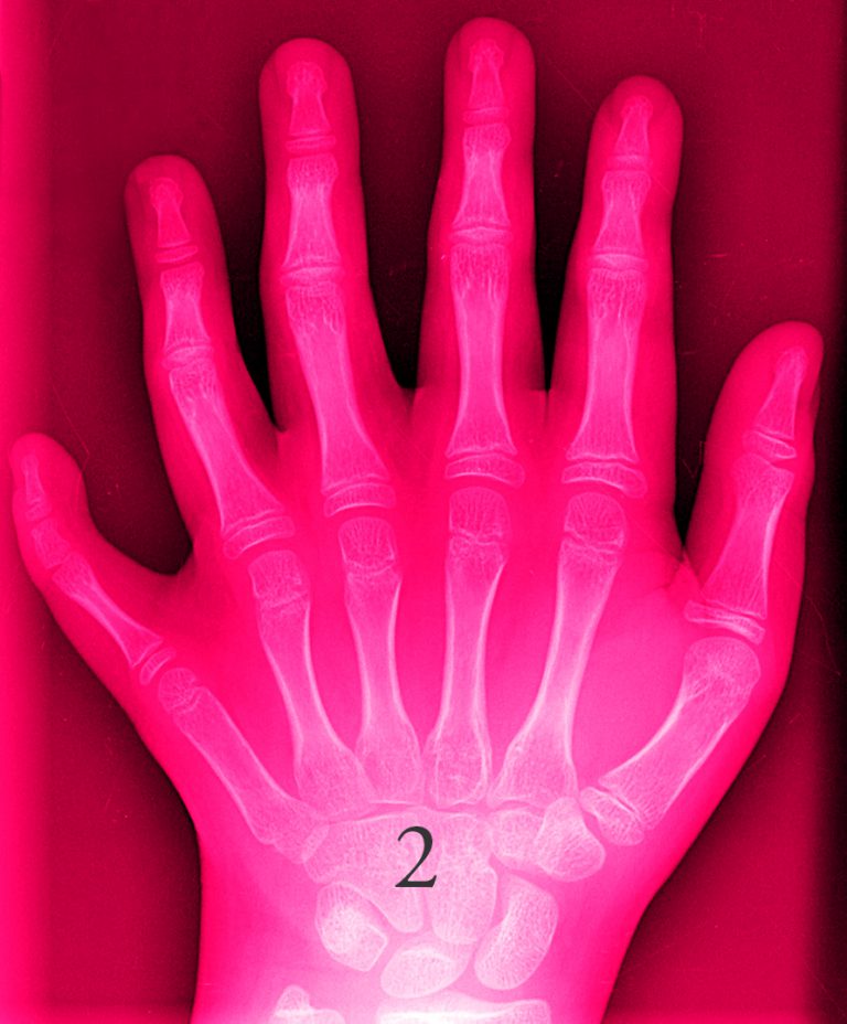 polydactyly_01_lhand_ap-pink